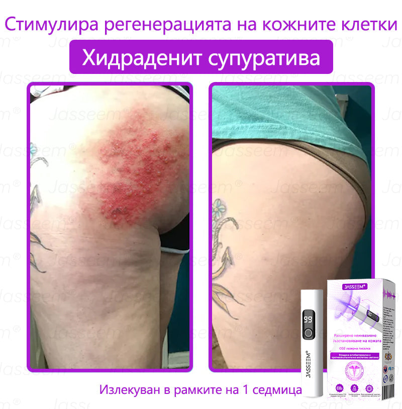 𝐉𝐚𝐬𝐬𝐞𝐞𝐦®✅ Усъвършенствана неинвазивна CO₂ лазерна писалка за грижа за кожата 💕(Нежно и ефективно премахва брадавици, бенки, старчески петна и кожни образувания – без болка и без усилие!)