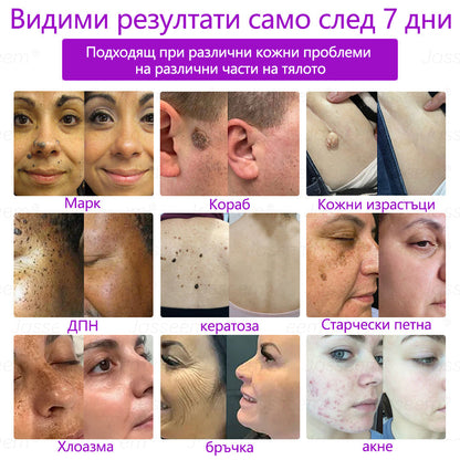 𝐉𝐚𝐬𝐬𝐞𝐞𝐦®✅ Усъвършенствана неинвазивна CO₂ лазерна писалка за грижа за кожата 💕(Нежно и ефективно премахва брадавици, бенки, старчески петна и кожни образувания – без болка и без усилие!)